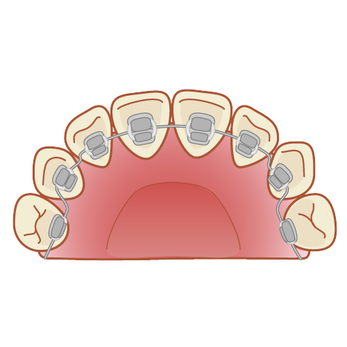 リンガル矯正（裏側矯正）